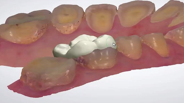 Tabletops And Non Prepared Veneers Design 口腔醫學院儀器設備使用教學 中山醫學大學雲端沐課學院